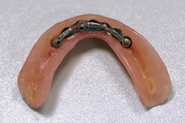 Протез нижней челюсти с системой балочной фиксации