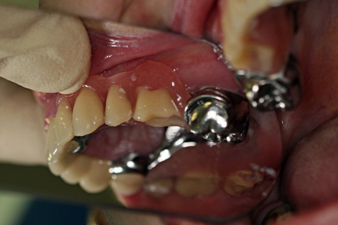 Вид протезов в полости рта